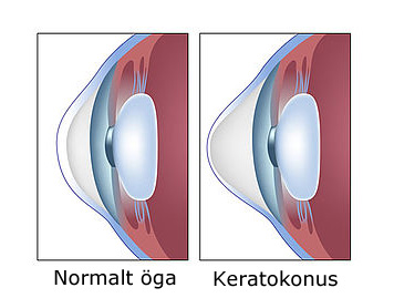 Keratokonus